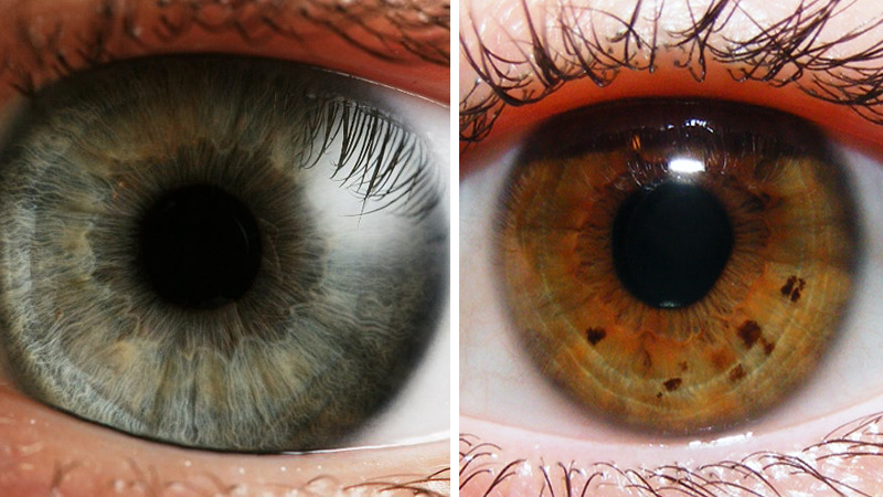 Collagen in iris, you can see your health